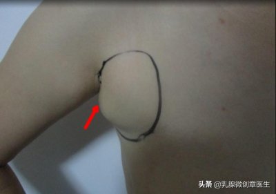 ​真副乳与假副乳有哪些区别？