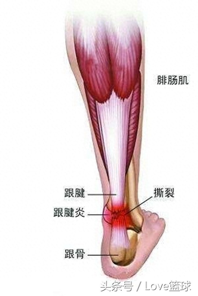 三张图告诉你，跟腱断裂有多恐怖！